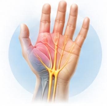 Carpal Tunnel Syndrome Treatment