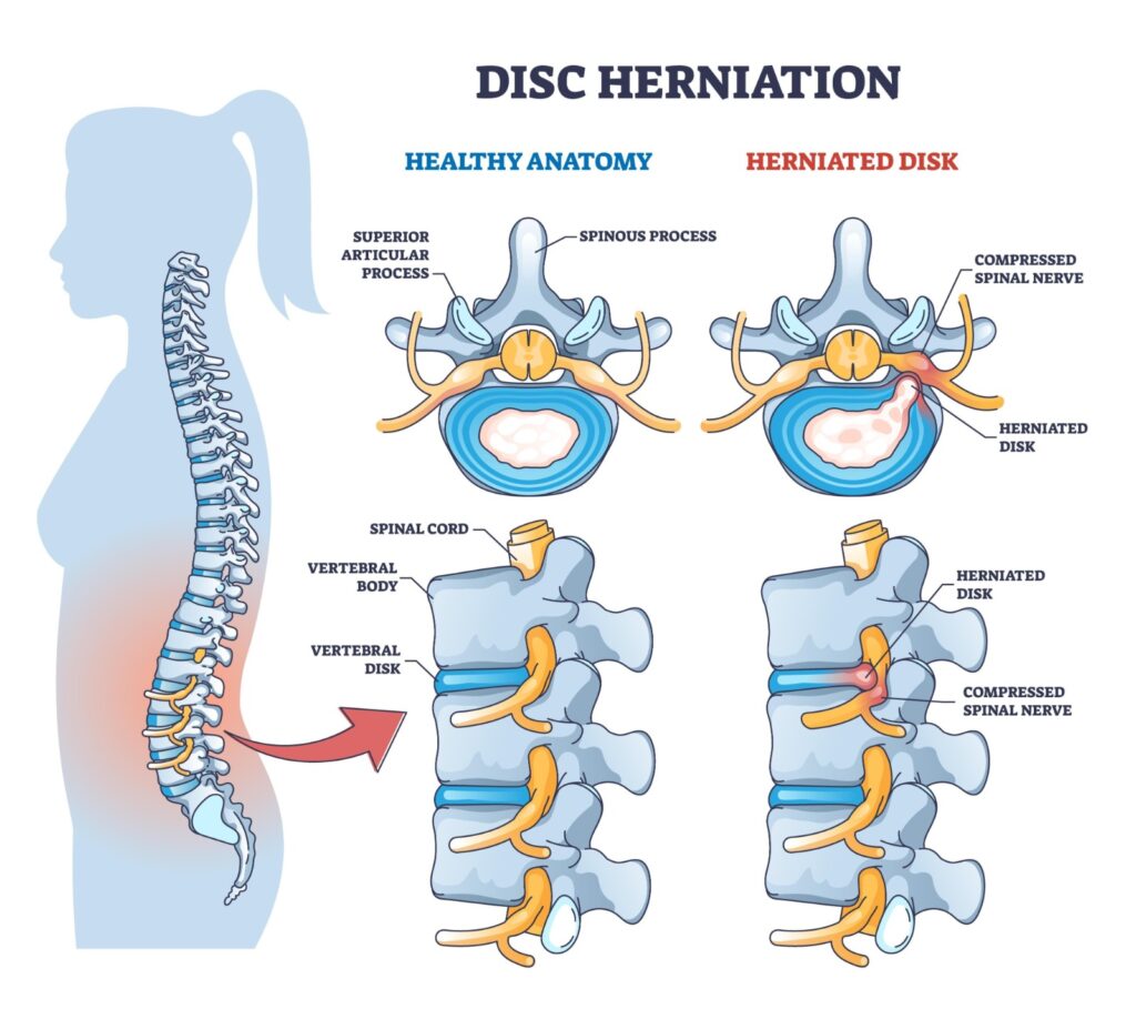 Illustration of healthy spine anatomy compared to a herniated disc with compressed spinal nerve, a common condition treated by a back pain doctor.